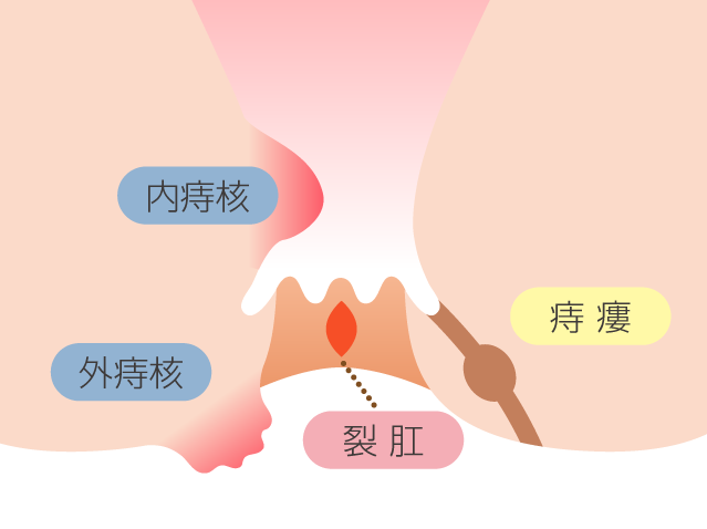 肛門にできる主な病気