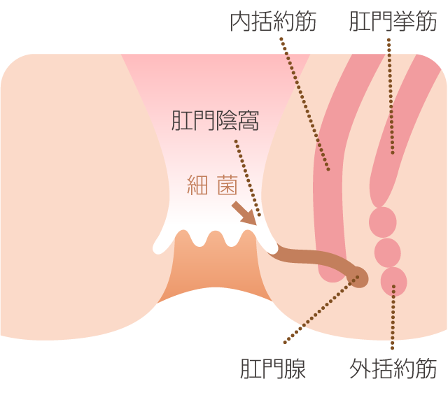 肛門陰窩から細菌が入り込む