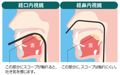 経口内視鏡と経鼻内視鏡では喉にスコープが触れるかどうかの違いがあります