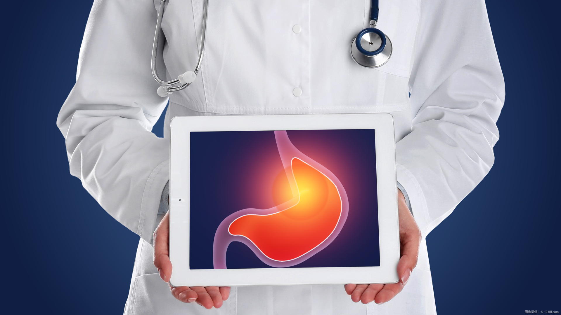 胃ポリープとは？